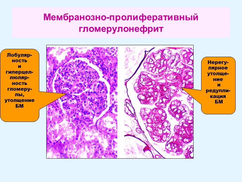 Мембранозно-пролиферативный  гломерулонефрит Лобуляр-ность  и гиперцел-люляр-ность гломеру-лы, утолщение БМ Нерегу-лярное утолще-ние  и